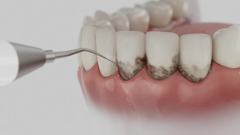 Trusted Wisdom Tooth Removal service in Riverside, ID - Dentist Open Now